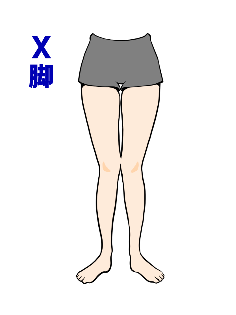 X脚
